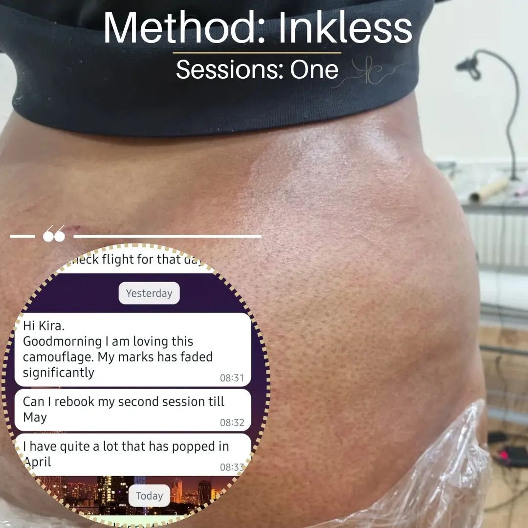 For shallow stretch marks, you can see great improvement from one session alone! This client will be having a second session to finalise her treatment and boost the longevity. On this skin tone, overall her healing has been getting better over time s