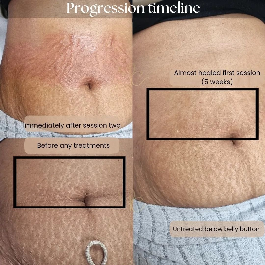 Realistic progression timeline on olive skin with ink camouflage 🫒 

Every client is different, but here's a possible example 

- It can take 6/8 weeks to heal the darker and more pigmented the skin is

- From one session the depth and texture will 