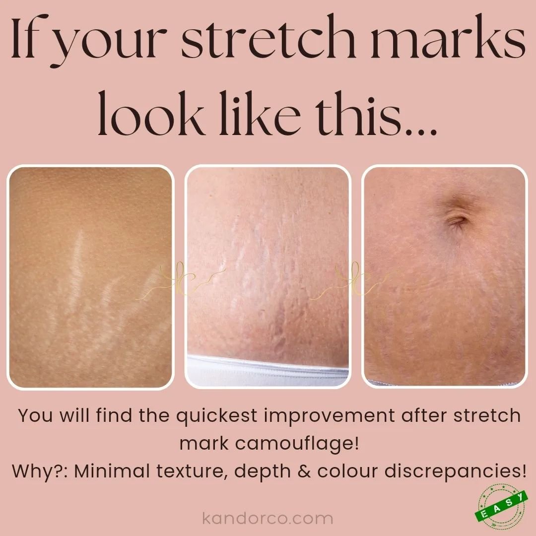 Setting expectations ✋️ I like to characterise stretch marks on a spectrum of easy - hard. If I was to put these types of stretch marks into a category it would be: easy. 

Although cases can be complex still, these types of stretch marks generally a