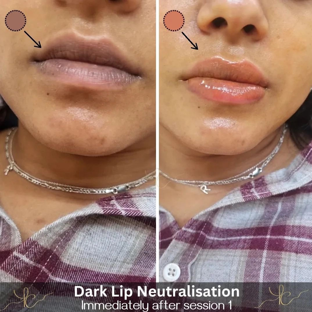 Neutralisation on lips that are used to smoking 🚬 

Smoking increases hyperpigmentation stubbornness and also lip skin thickness. For this client she needed a few more passes to get decent coverage. In 8/10 weeks we will go over her lips once more t