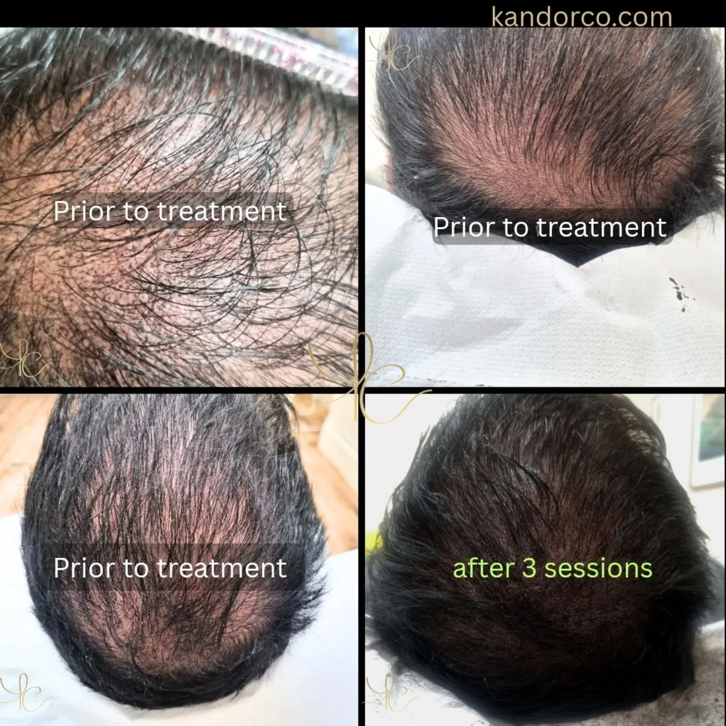 Hair density magic 🎩 

Using semi permanent makeup techniques, faux hair follicles are mimicked to create the illusion of a fuller, thicker head of hair. This works post hair transplant, or if you just want some additional years to what you have lef