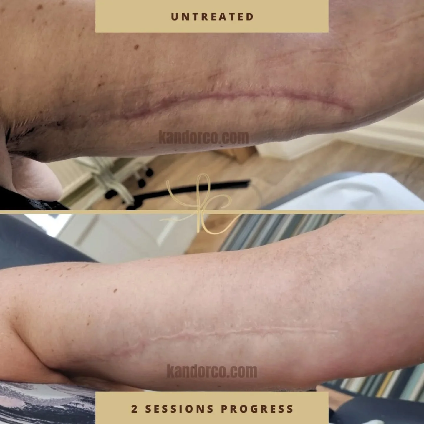 Transformation over 2 sessions 🥳

It's important to take photos during the process so you can remember how far you have came! It was amazing to look back at the before image upon entering on session one to where we are at now 

Time taken - 45 minut