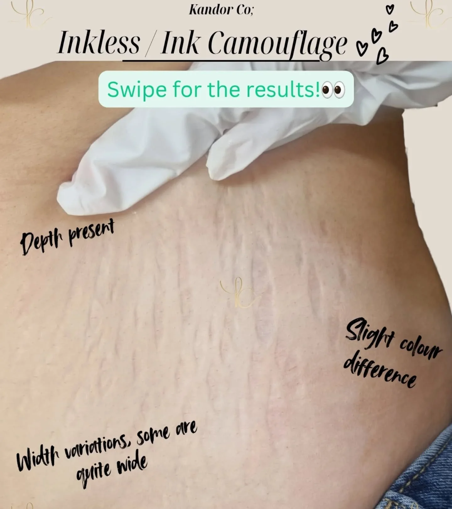 A case of brilliant results! 🩷

This client only needed 2 sessions to start seeing fabulous results on even the thicker stretch marks! Results are seen from the first session however these are usually on the thinner and less deep stretch marks. On s