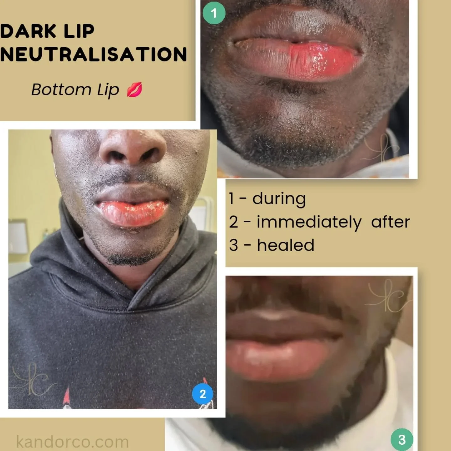 Singular lip neutralisation 💙

Goal - lighten the bottom lip to make it look more pink and vibrant and remove dark colours 

Time - 1 hour 15 minutes

Healing - 8 weeks 👄

⠀⠀⠀⠀⠀⠀⠀⠀⠀⠀
⠀⠀⠀⠀⠀⠀⠀⠀
⠀⠀⠀⠀⠀⠀⠀⠀⠀⠀
⠀⠀⠀⠀⠀⠀⠀⠀
#lipneutralisation #darklipneutralis