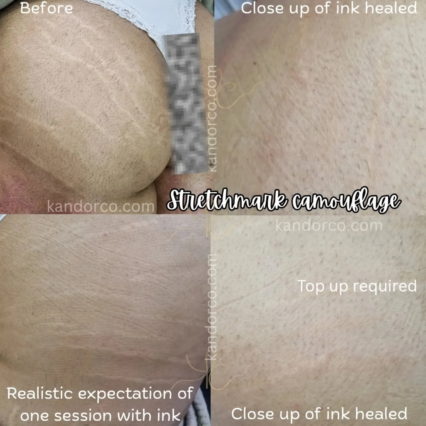 Case study 📖 

This client had pale stretchmarks across the buttocks and was certain she wanted ink and the &quot;quickest results&quot; 🫨

To compromise we did use ink on session one to build some opacity and these were the results, an improvement