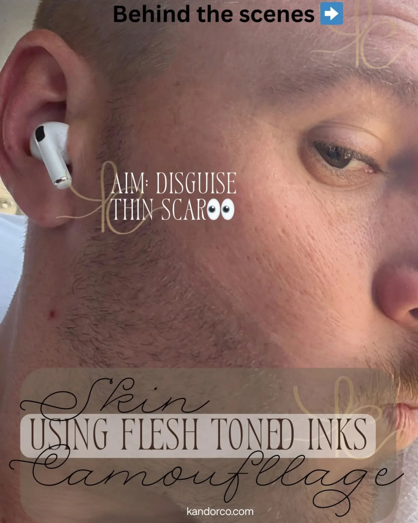 Behind the scenes journey on a smaller face scar 🩹

🤍Flat white scars are nice and simple. 
🎨The clients colour can be mixed up and used from day one without any preparation
⏳️ After a few weeks of skin healing and cell turnover the scar is able t