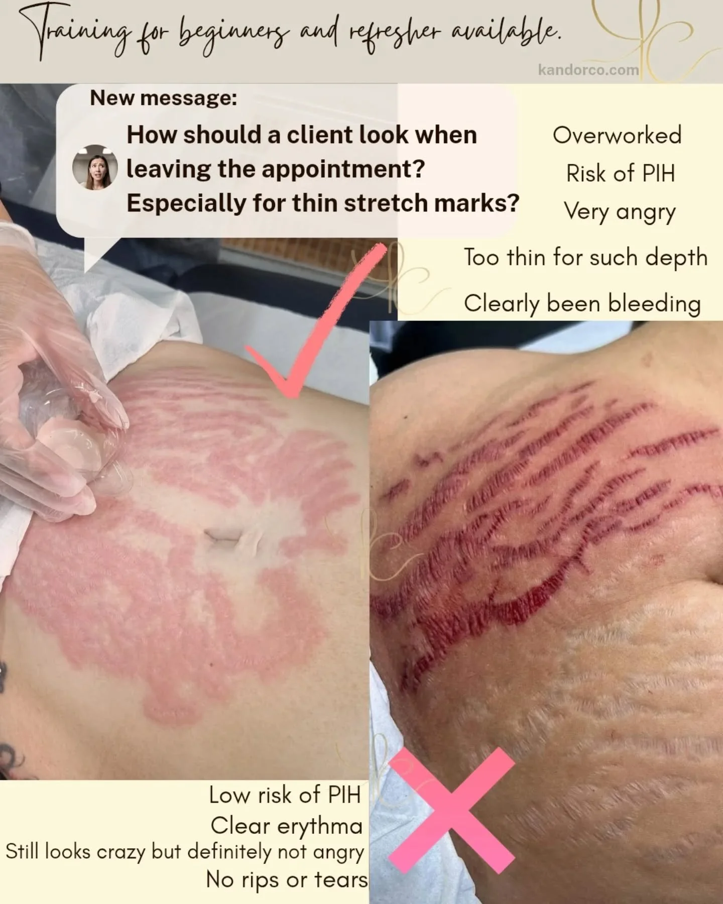 😨😱 did you know stretch mark camouflage looked like this immediately after? Theres a lot of discombobulated other halves when our clients go back home 😅

But - if youre having a simple stretch mark treatment you should not see blood during your ap