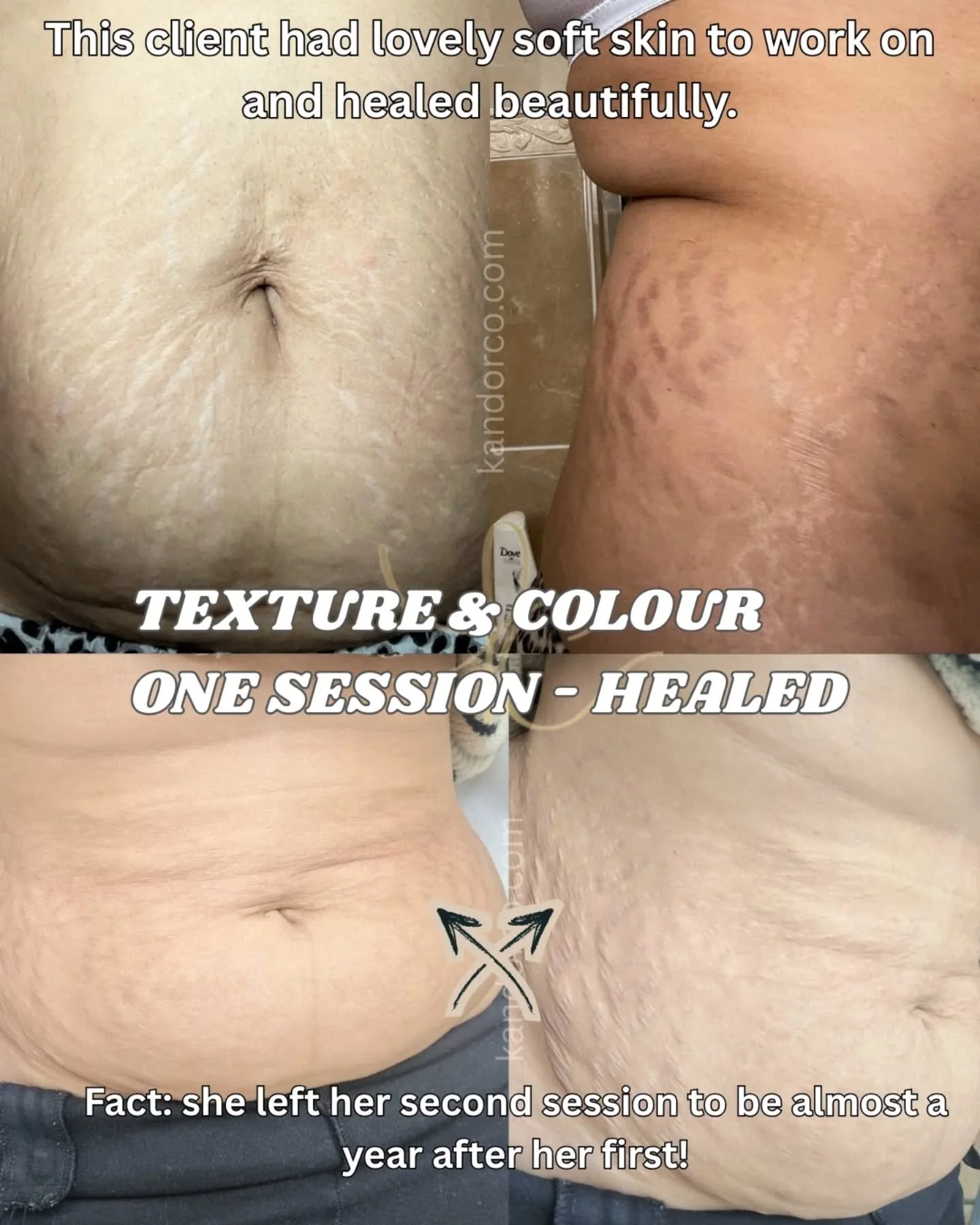 Case study 📖 

This client had such a soft tummy ☁️

Both ink and serum flowed into the skin like a dream ✨️ 

Healing happened within the 4 week time frame ⏳️

Results were seen from session one, especially around the middle, thinner stretch marks 