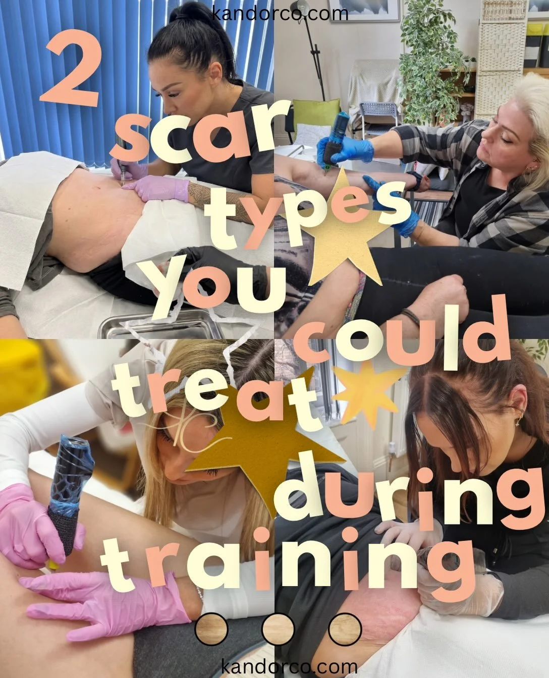2 of the wide variety of scar types you can treat during training and your own clients - 💡

Striae - most common - stretch marks 
Brachioplasty - fairly common - arm lift scars 

#scarcamouflageuk #scarcamouflagetraining #stretchmarkcamouflage #inkl
