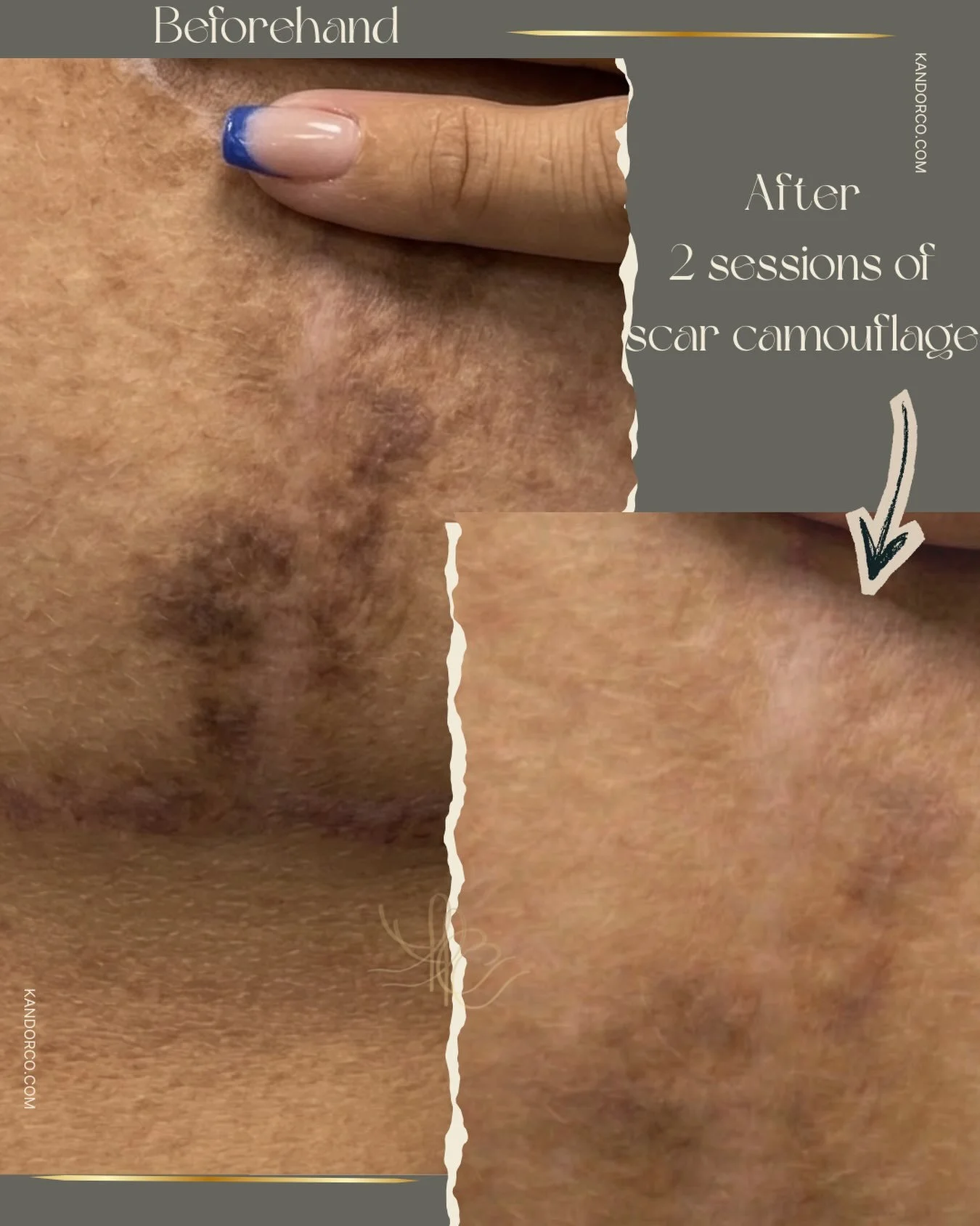 2 healed sessions of scar camouflage on an anchor scar focusing on the horizontal scarring and hyperpigmentation. A couple more sessions are needed to finalise the results🌺

#scarcamouflage #scarcamouflageuk #medicaltattoo #skincamouflage #scarcamou