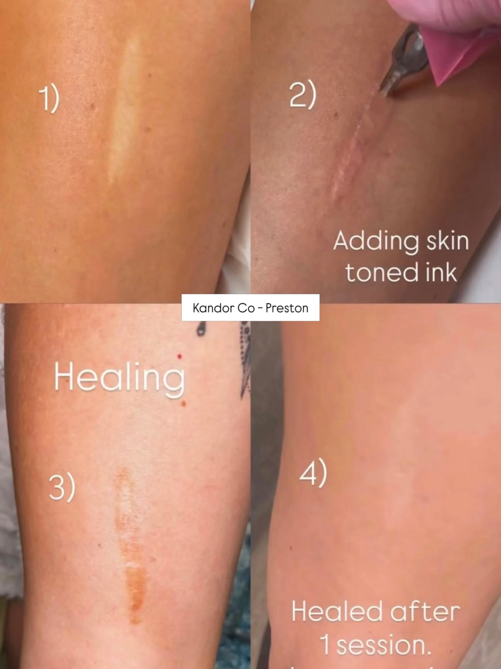 One session healed results on a flat white scar carried out by V in Preston ❤️ Coverage level is already great after one session,  for full coverage you would usually need 2/3 sessions on something like this:

Looking for a practitioner in the North?