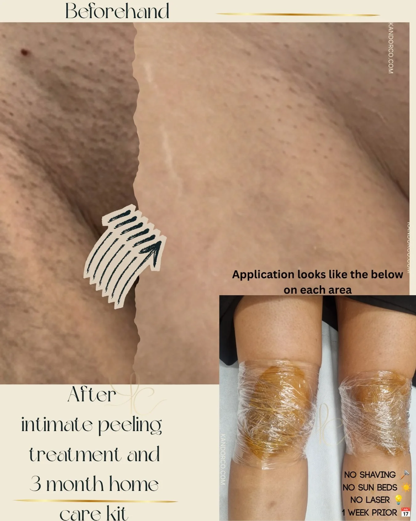Medical grade intimate lightening solution 🍑🥝

A treatment in clinic followed by 6 month minimum aftercare to help encourage even more pigment removal at cellular level to minimise the risk of the hyperpigmentation coming back 

#skincamouflage #in