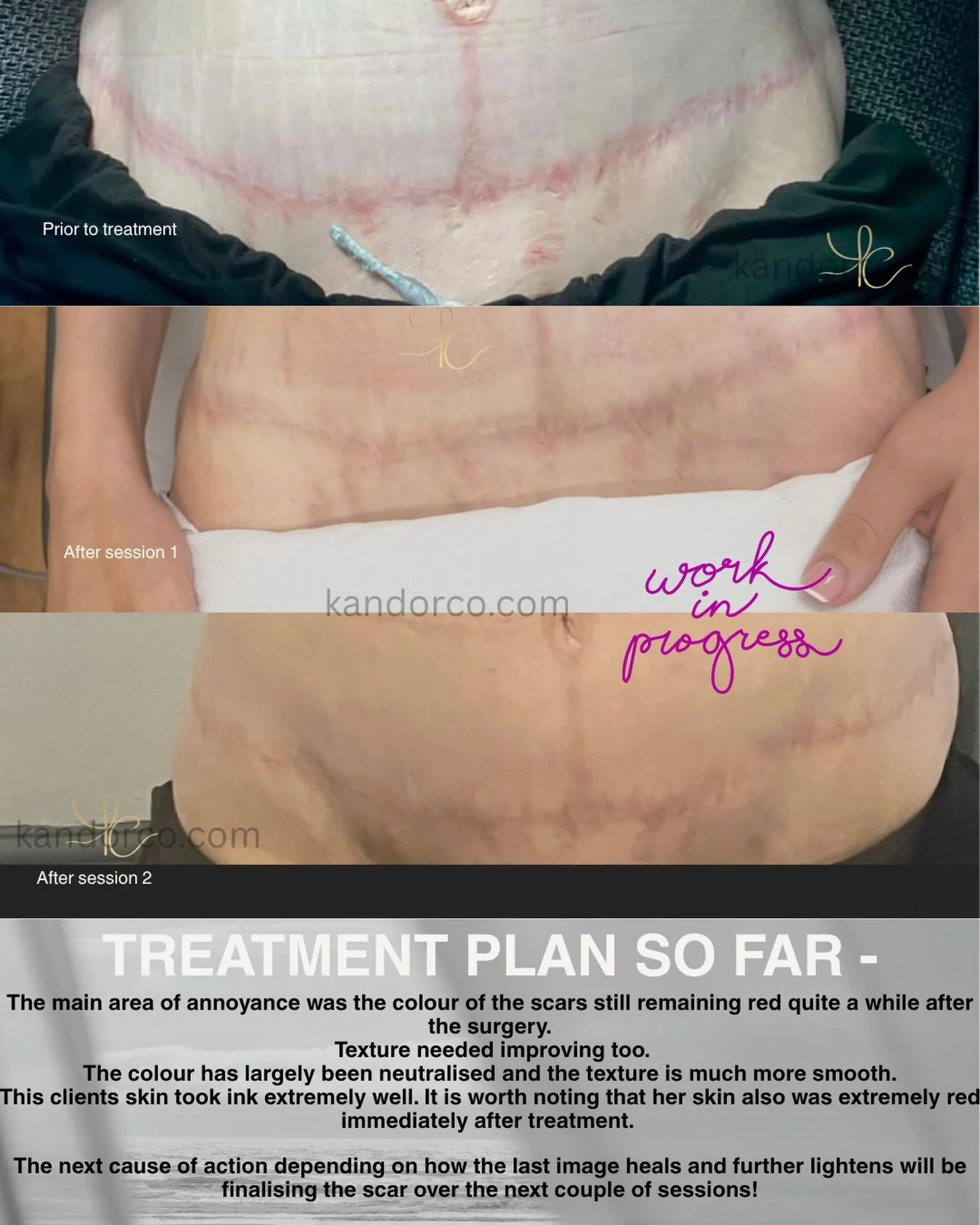 Progression after 2 sessions 🎀

The main area of annoyance was the colour of the scars still remaining red quite a while after the surgery.
 Texture needed improving too.
The colour has largely been neutralised and the texture is much more smooth.
T