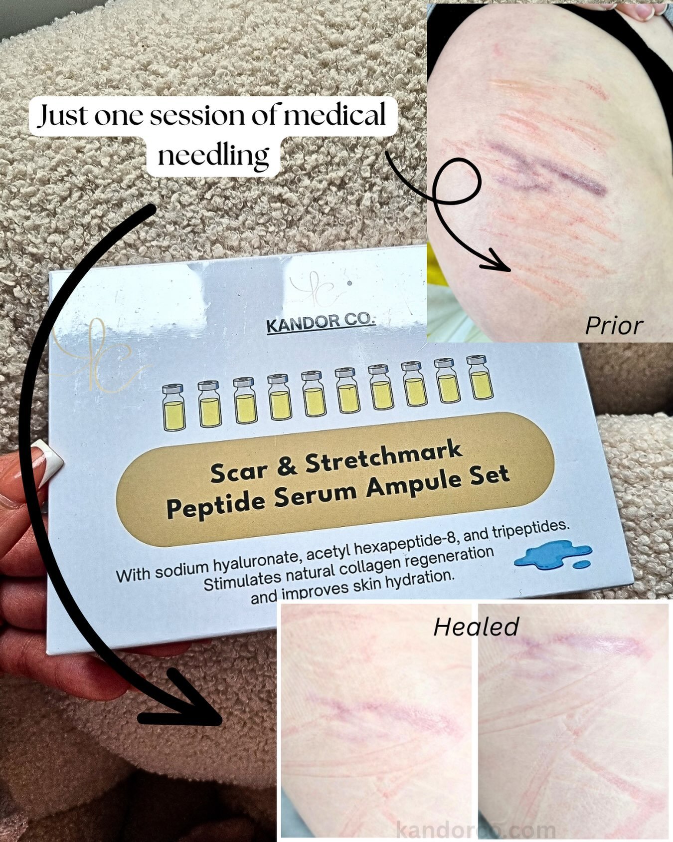 So far after one session difference using serums (aka medical needling, mca needling). The purple scar has been flattened and lightened without the use of any inks and the surrounding scars and stretch marks have faded. 🎀

#scarcamouflage #skincamou