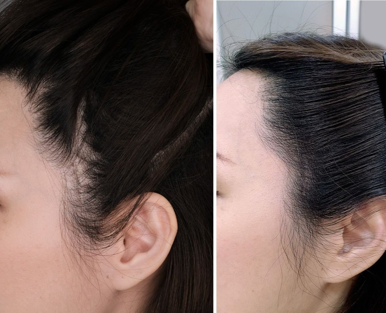 Pay As You Go - Half Head Scalp Micropigmentation Session