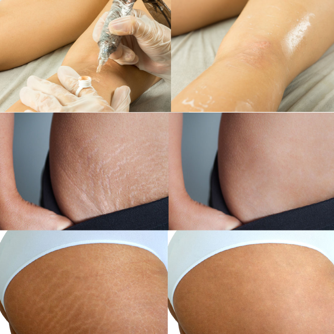 Women of Color Stretch Mark Camouflage  Studio Conceal