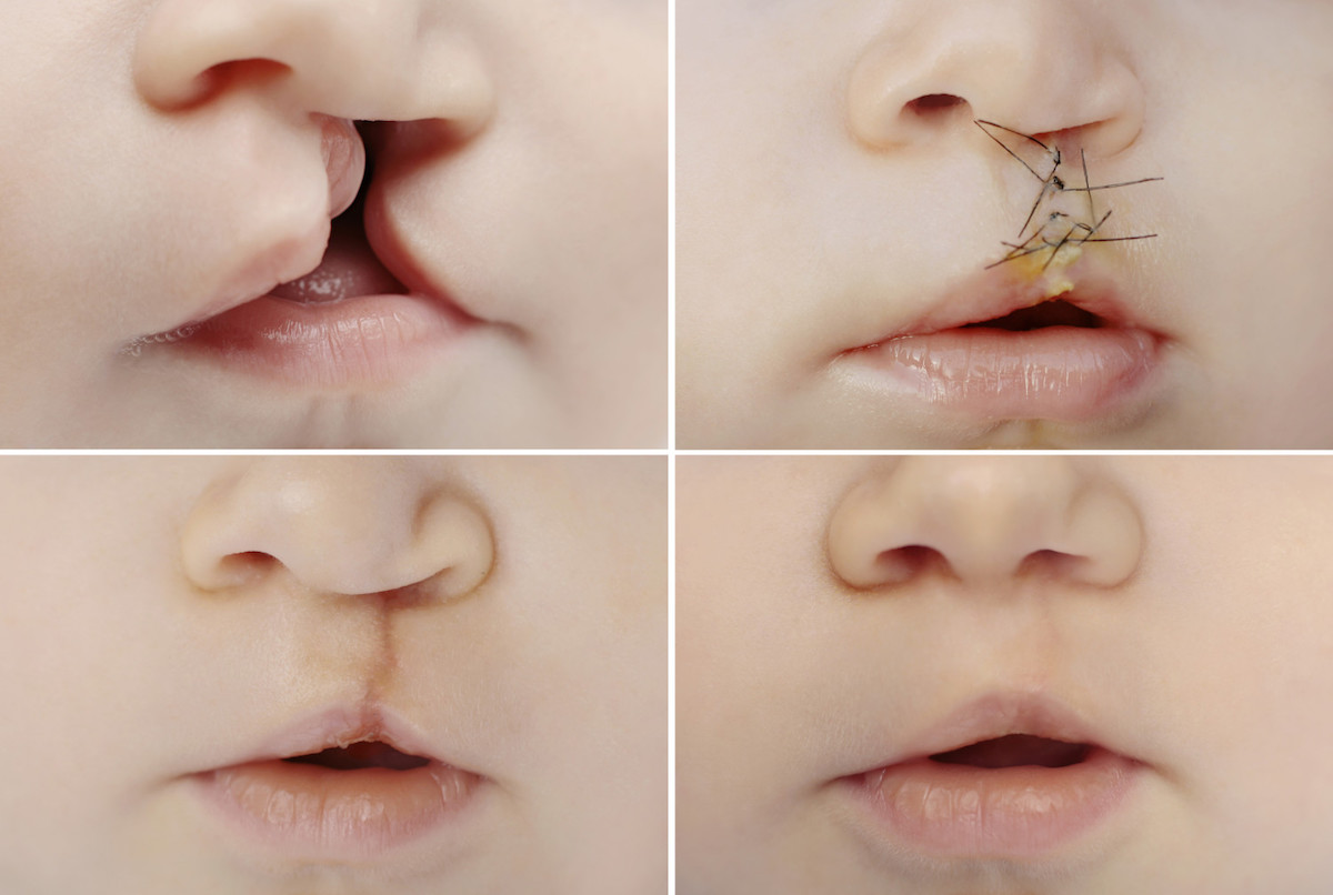 cleft palate surgery.jpg