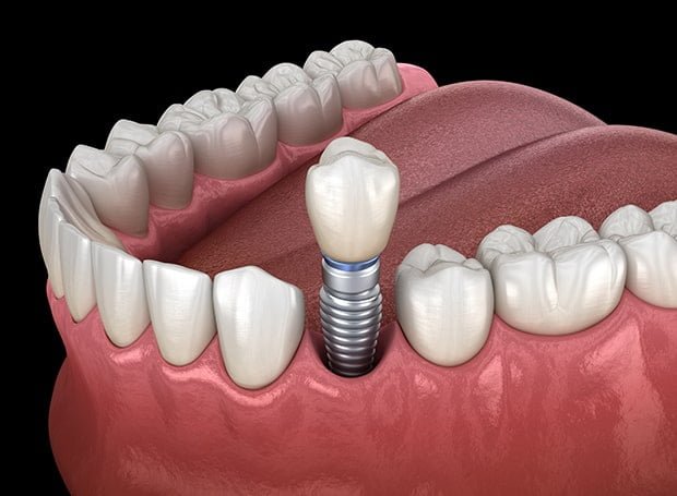 Dental implants