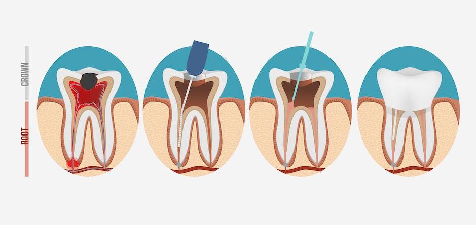 Root Canal and Endodontics