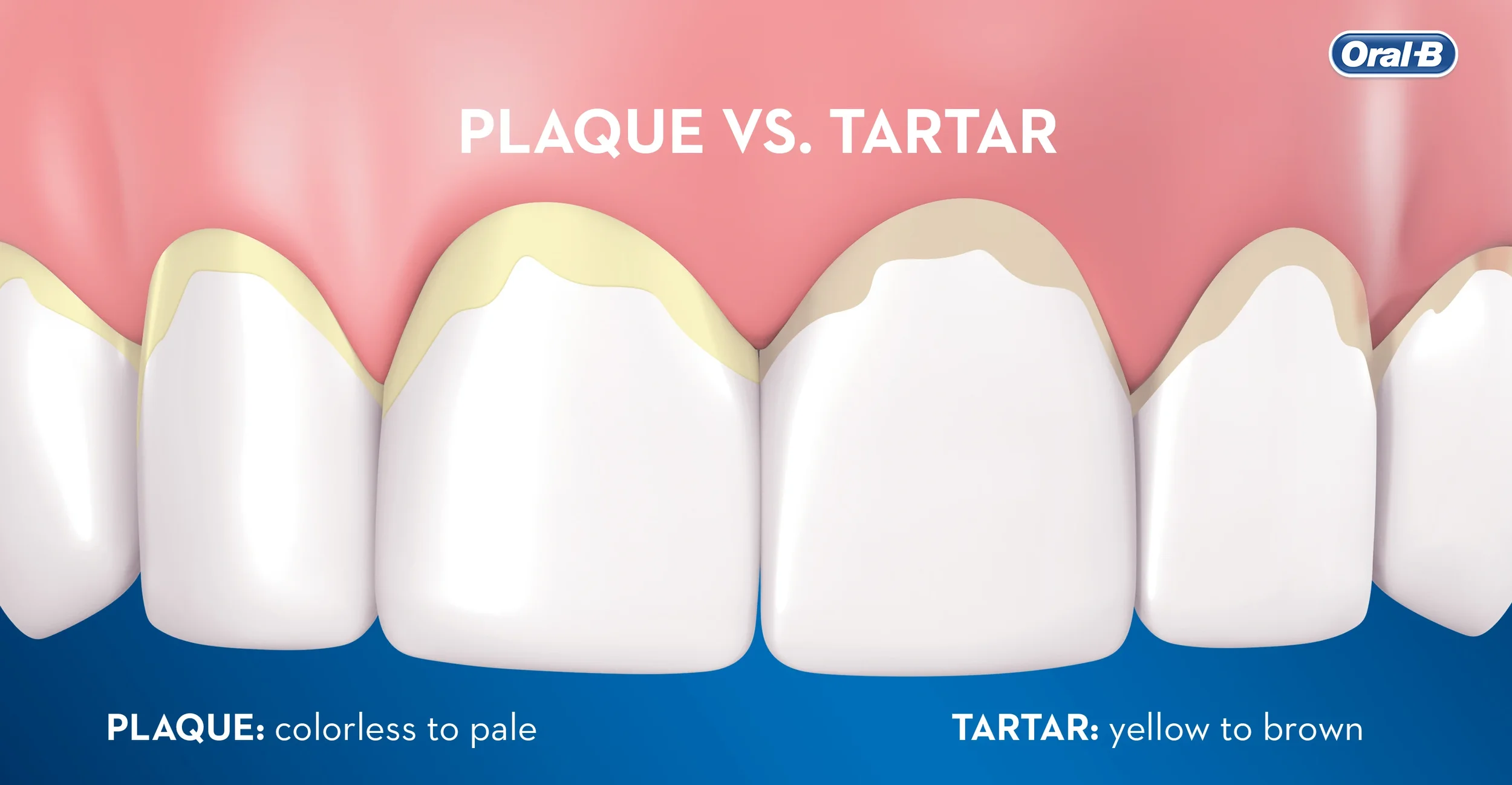 The Best Ways to Reduce Build-Up of Plaque and Tartar