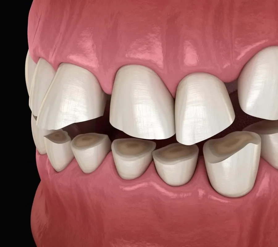 Grinding Your Teeth? Why You Shouldn’t Ignore It!