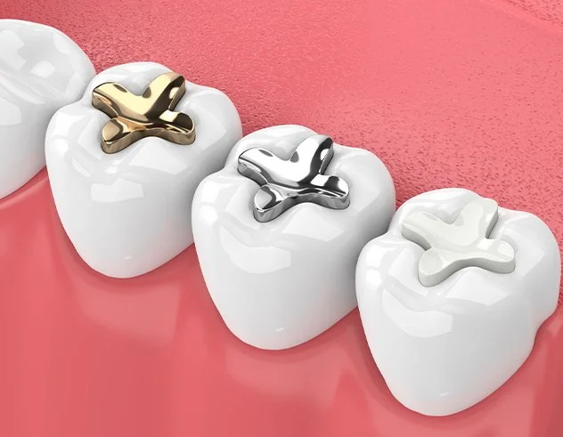 The Benefits of White Tooth-Coloured Fillings and Why Amalgam Fillings are Being Phased Out