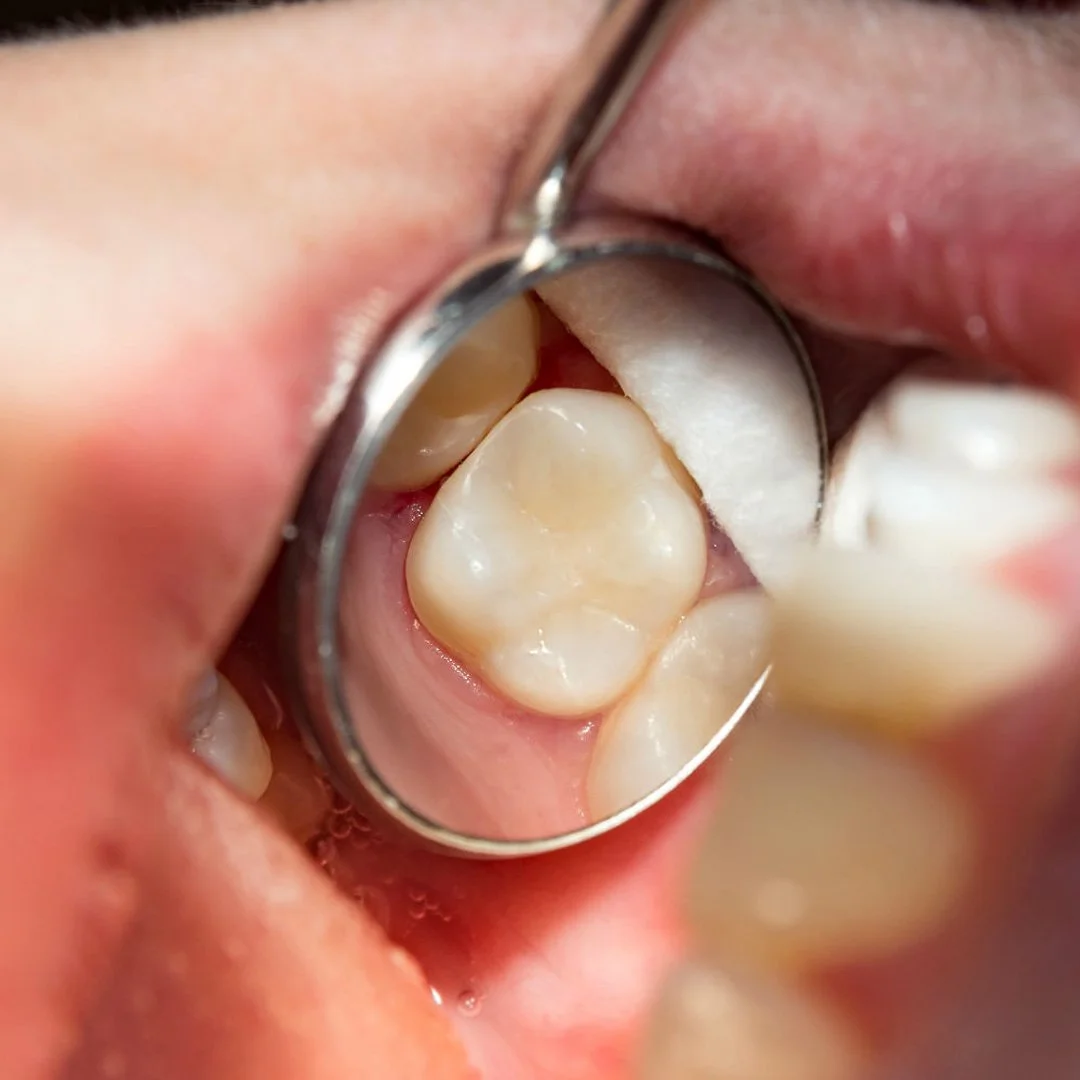 How Much Does a Filling Cost in the UK?