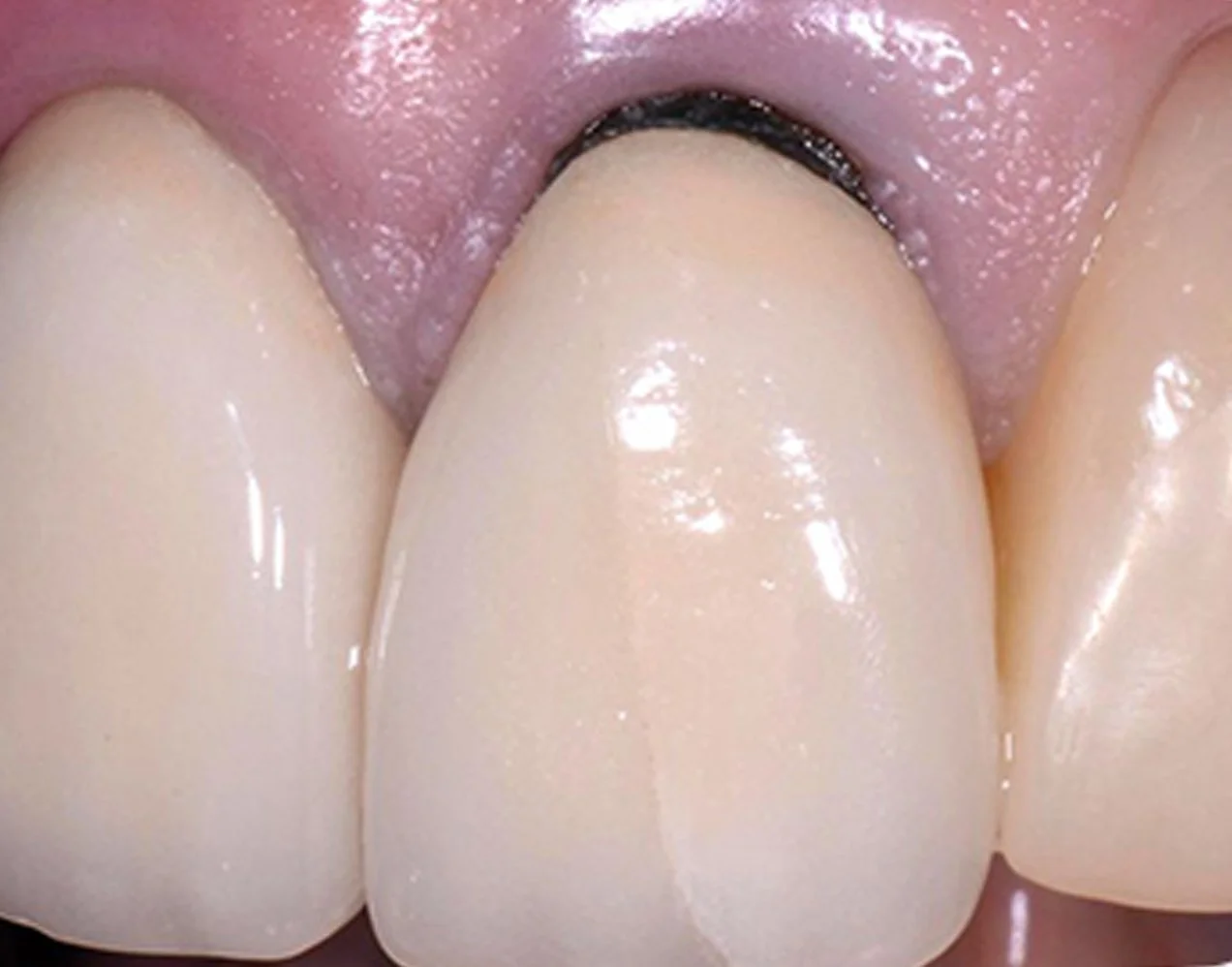 Why Is There a Dark Line Around My Filling or Crown?