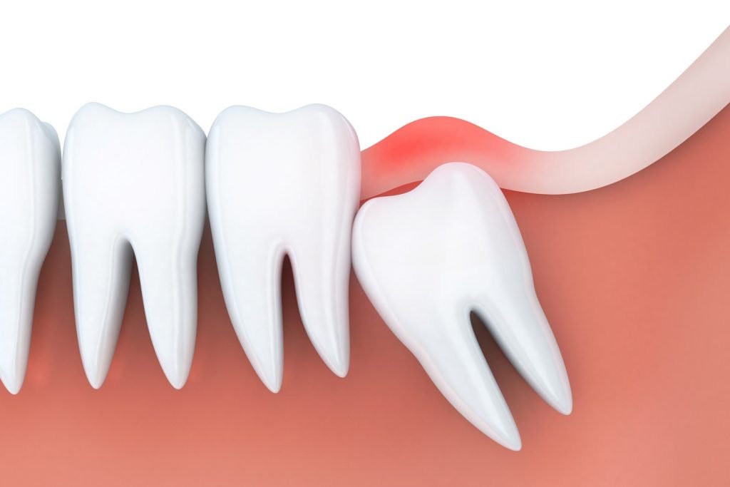 Wisdom tooth extractions 