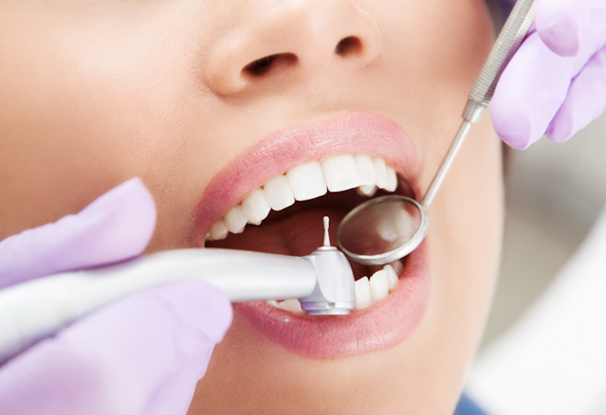 Dental Fillings (white fillings)