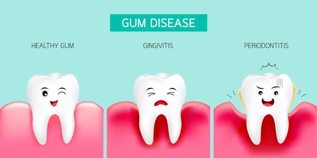 The different stages of dental gum disease