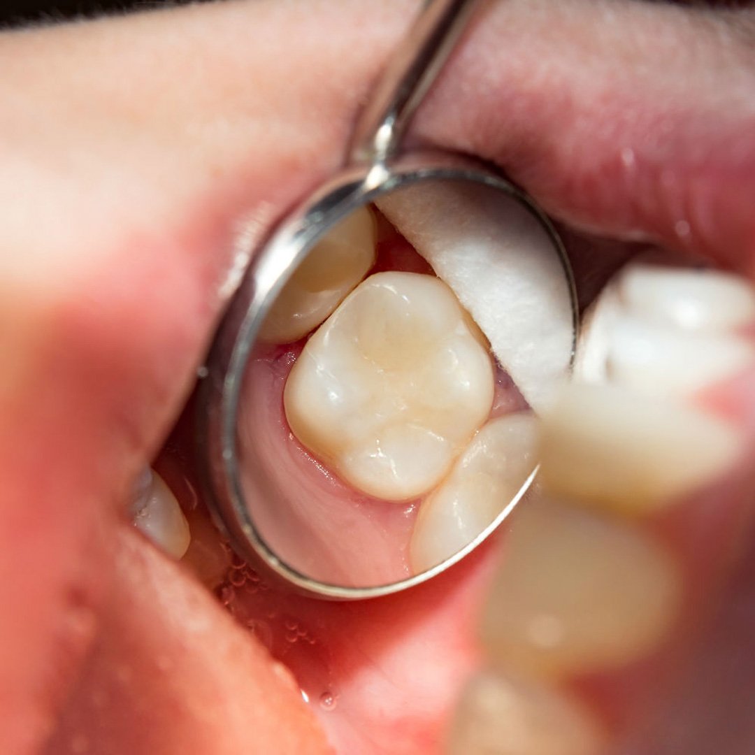 White composite dental filling UK