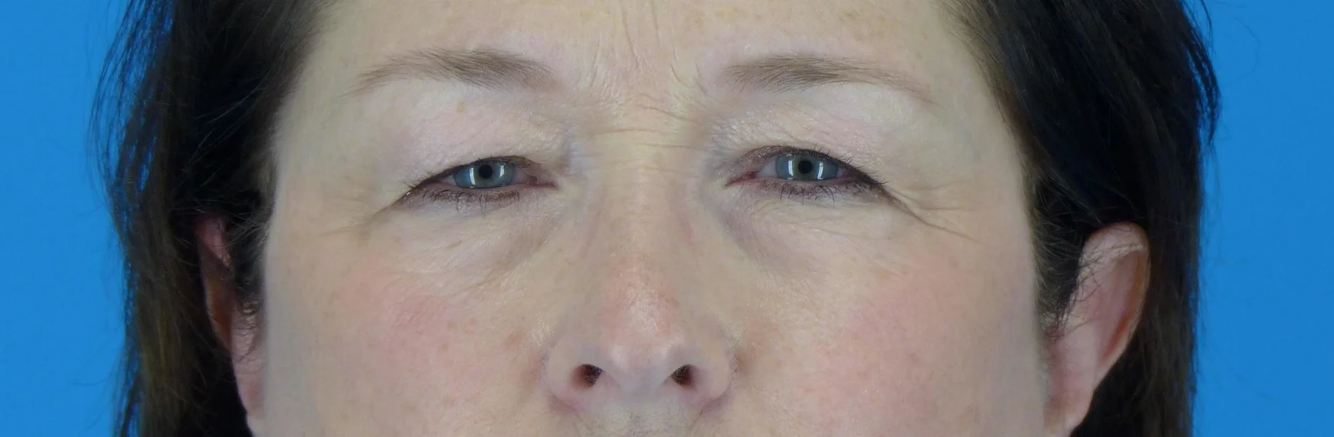 eyelid-surgery-before-and-after.jpg