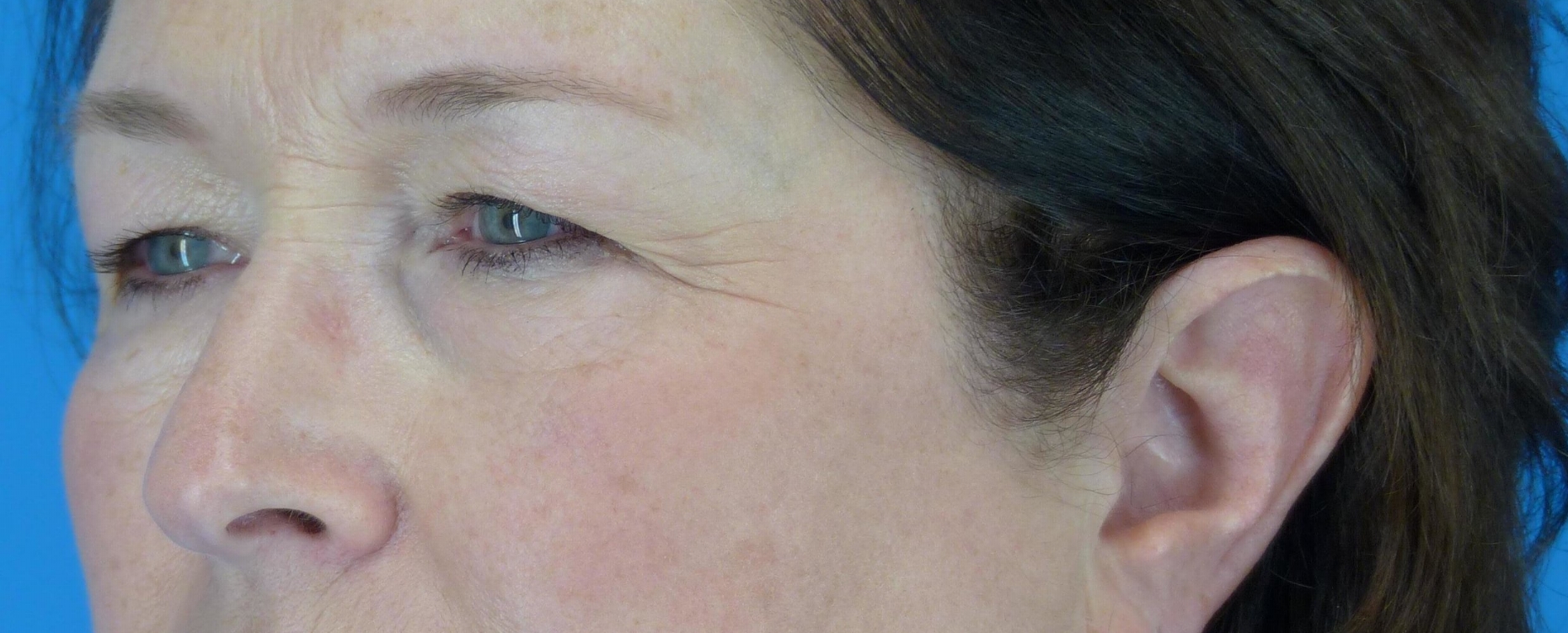 eyelid-surgery-before-and-after.jpg