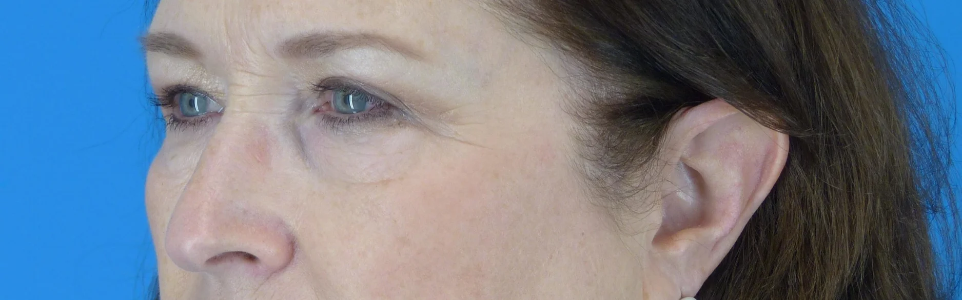 eyelid-surgery-before-and-after.jpg