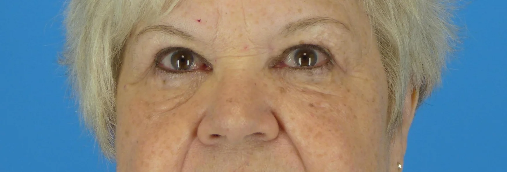eyelid-surgery-before-and-after.jpg