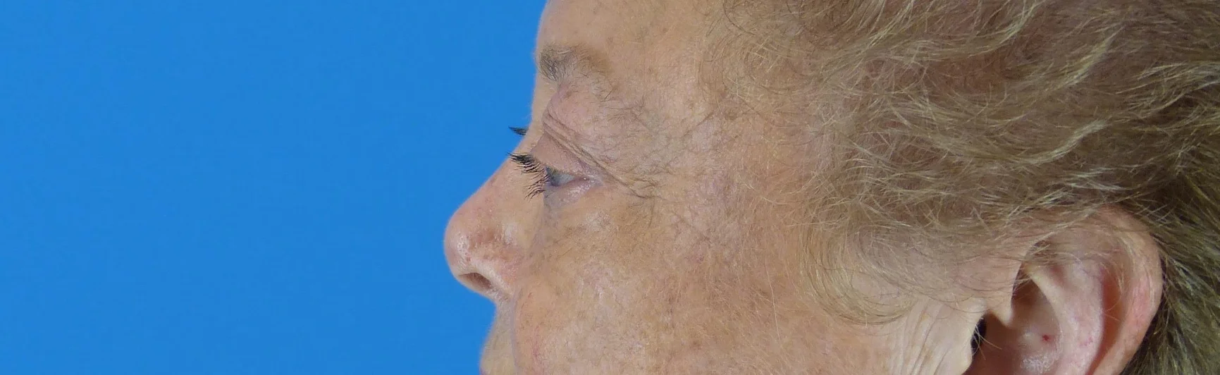 eyelid-surgery-before-and-after.jpg