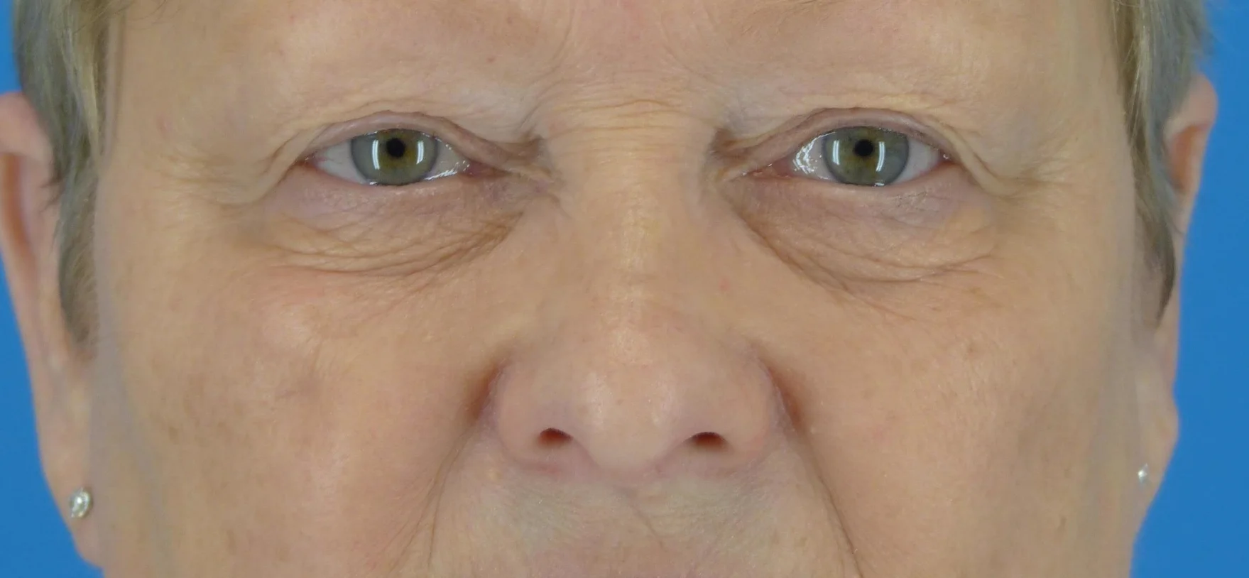 eyelid-surgery-before-and-after.jpg