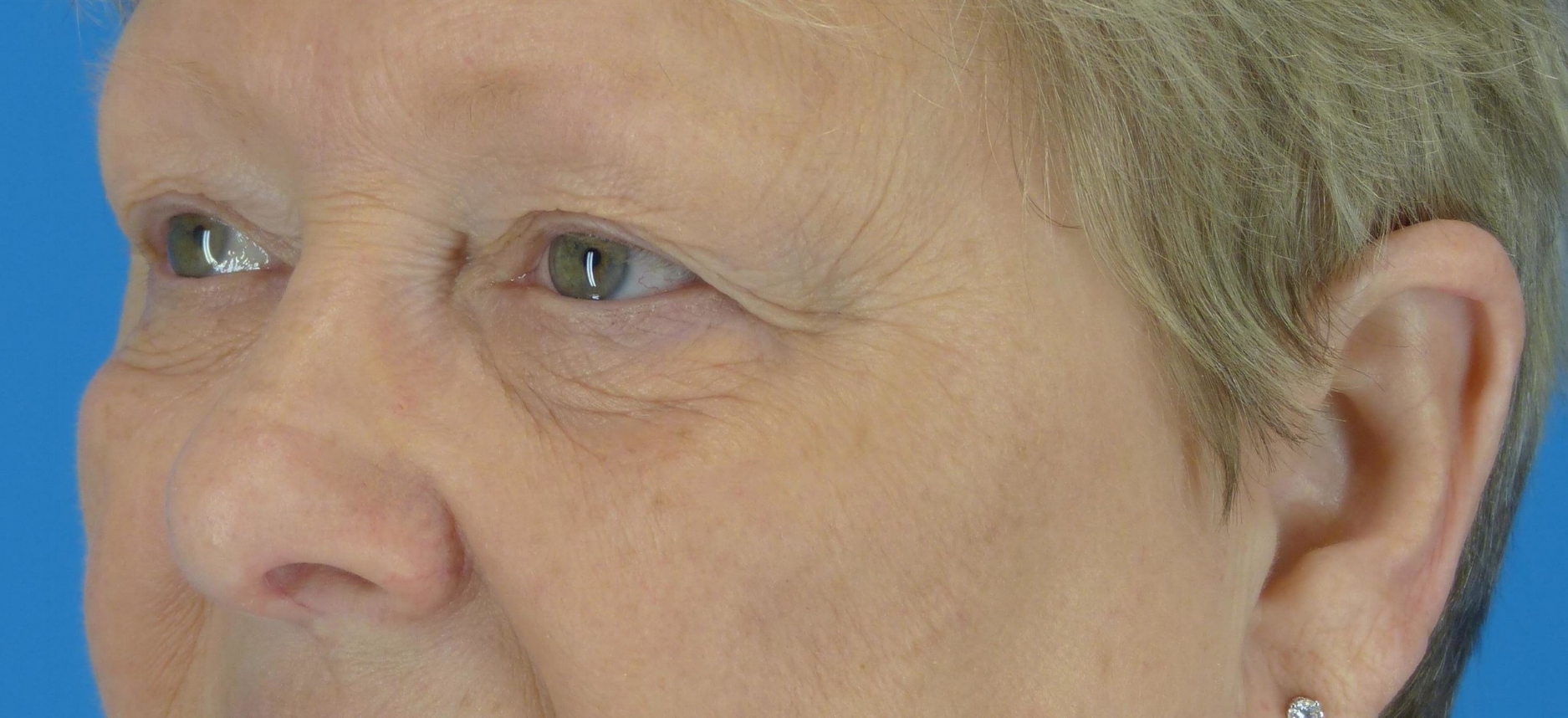 eyelid-surgery-before-and-after.jpg