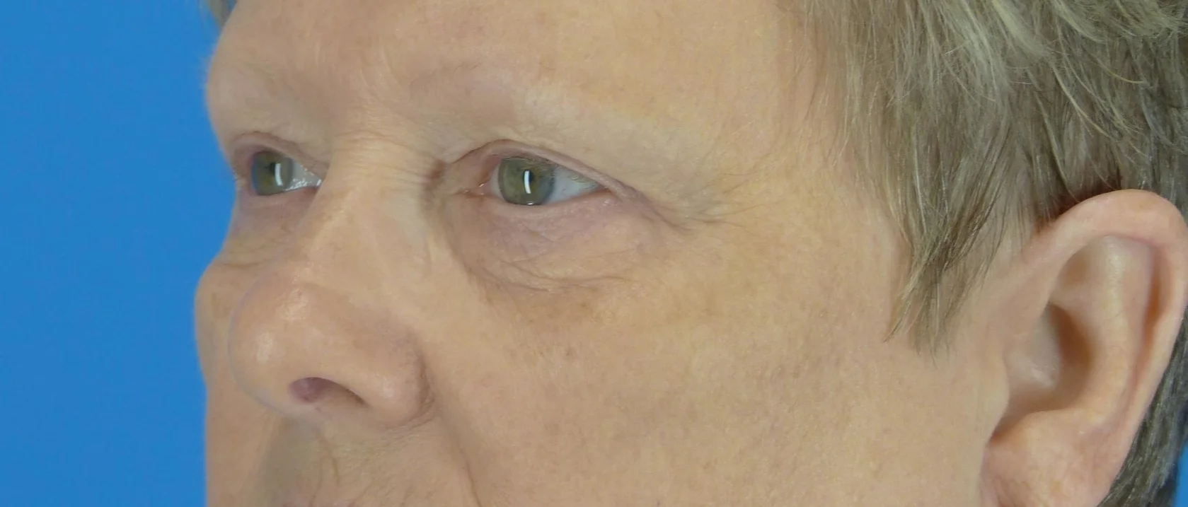 eyelid-surgery-before-and-after.jpg