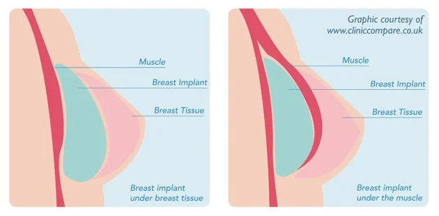 breast augmentation-jonesboro-ar.jpg