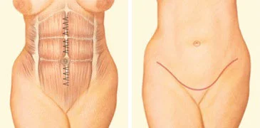 tummy-tuck-jonesboro.jpg
