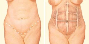 tummy-tuck-jonesboro.jpg