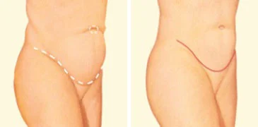 tummy-tuck-jonesboro.jpg