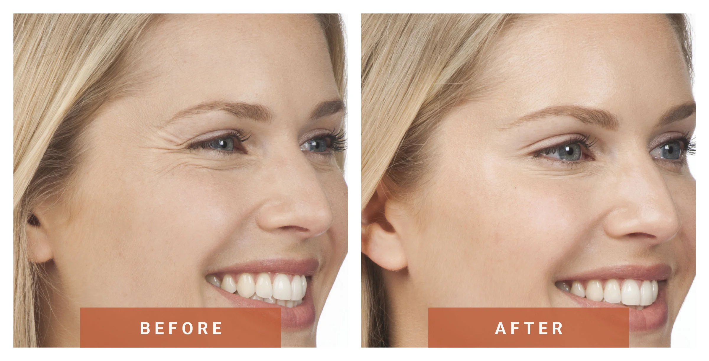 Dysport® was used to soften crow's feet on this patient.
