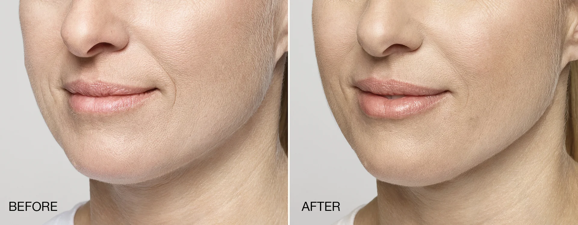 Here, Restylane® Silk was used to add fullness to the lips.