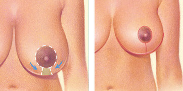 A keyhole or racquet-shaped pattern with an incision around the areola and vertically down to the breast crease.