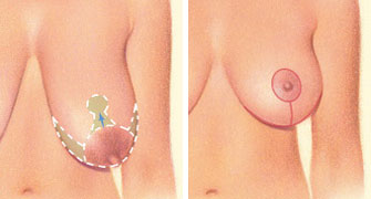 Around the areola, vertically down from the breast crease and horizontally along the breast crease.