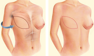 Occasionally, the flap can reconstruct a complete breast mound, but often the latissimus flap provides the muscle and tissue necessary to cover and support a breast implant.