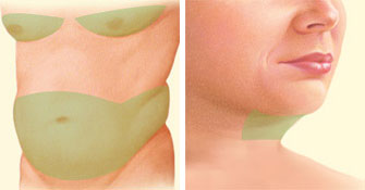 liposuction-jonesboro-ar.jpg